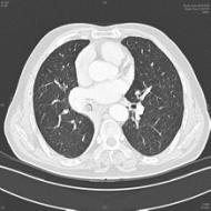 76岁老人咳嗽发烧6天，一查竟是「肺错构瘤」长在支气管里