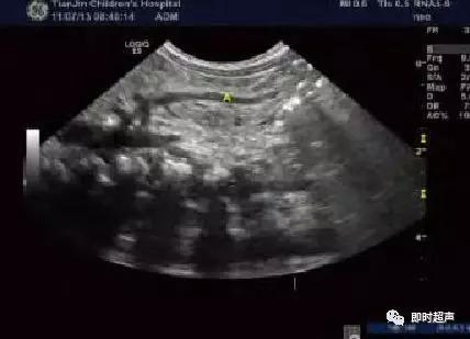 小儿消化道急症超声