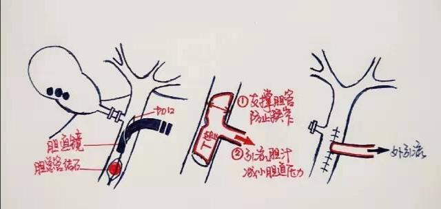 腹部手术完为什么要戴腹带,腹部手术之后为什么胀气