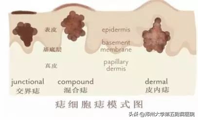 色素痣病理报告,头上色素痣图片