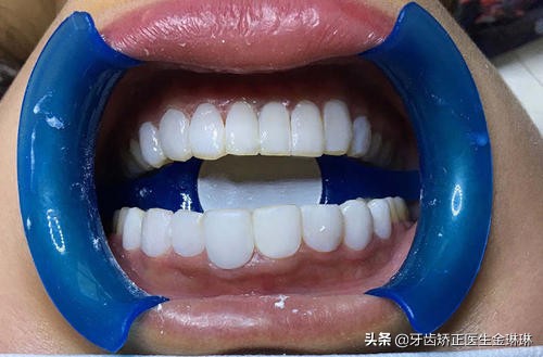 烤瓷牙颜色太黄了怎么办,烤瓷牙变黄了怎么变白