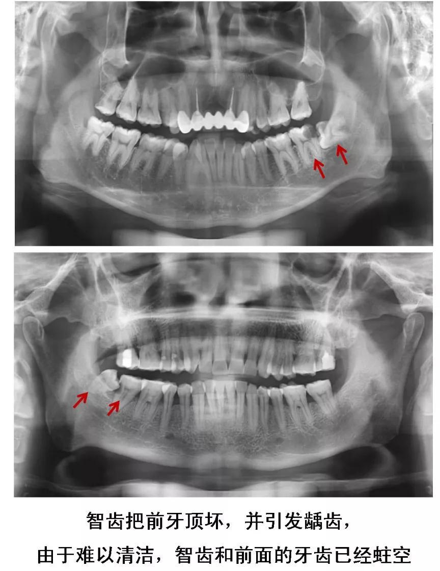 明星拔了智齿有垮脸的吗,明星拔完智齿