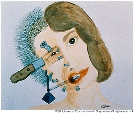 什么是偏头痛偏头痛的症状有哪些,偏头痛是什么原因引起的神经病变