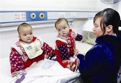 中国首例坐骨连体双胞胎现状,坐骨连体双胞胎多大分离