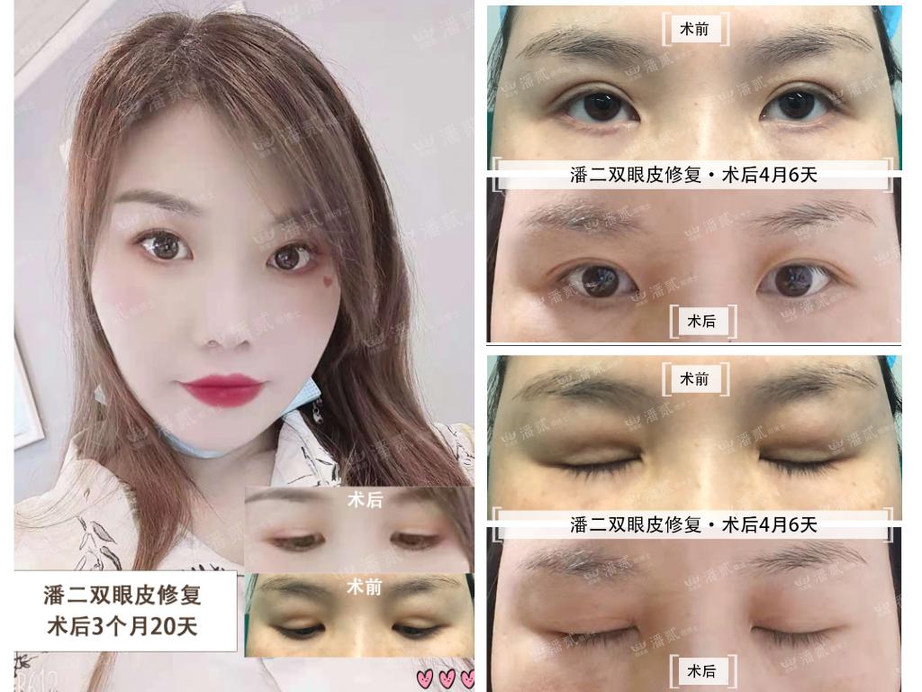 做过韩式三点双眼皮还能重新做吗,韩式三点双眼皮5年后修复