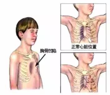 鸡胸是怎样形成的需要怎样去治疗,鸡胸的形成原因及矫正方法