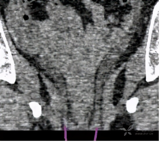 尿路梗阻导致肾积水不及时治疗,双肾积水是尿路梗阻吗
