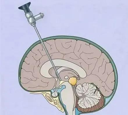 脑室积水有哪些症状,脑积水的水是什么样子
