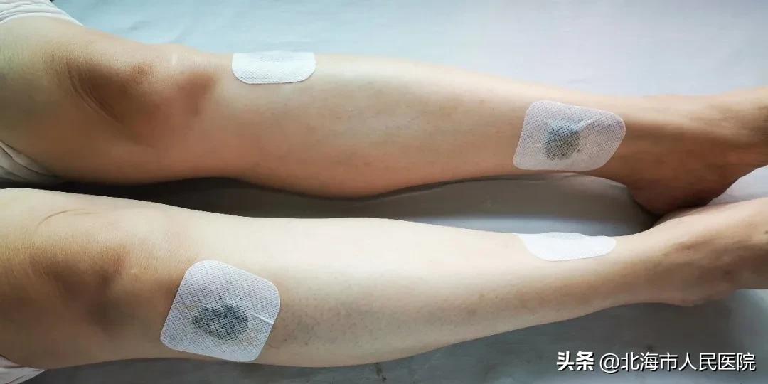 冬病夏治三伏贴,冬病夏治三伏贴该怎么贴