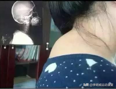 一招解决颈后大包,纠正颈后大包练哪些肌肉