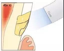 楔状缺损坑,较深的楔状缺损