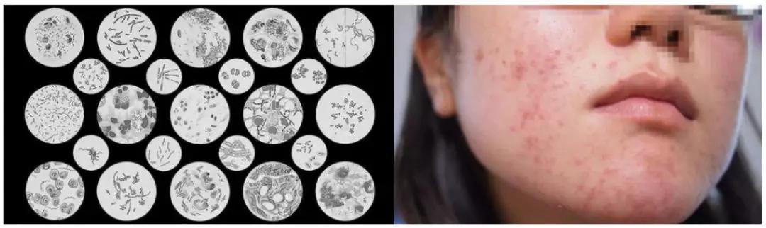 蜂胶消炎祛痘,蜂胶治疗皮癣吗