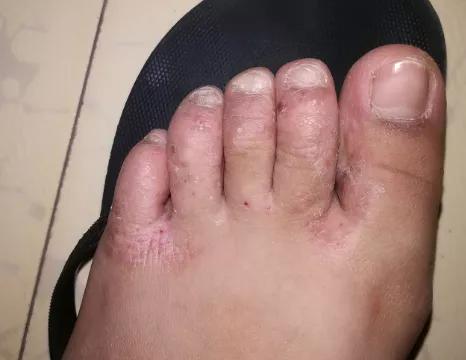 手上长水泡很痒怎么治疗,手上长冻疮又痒又痛又肿怎么办