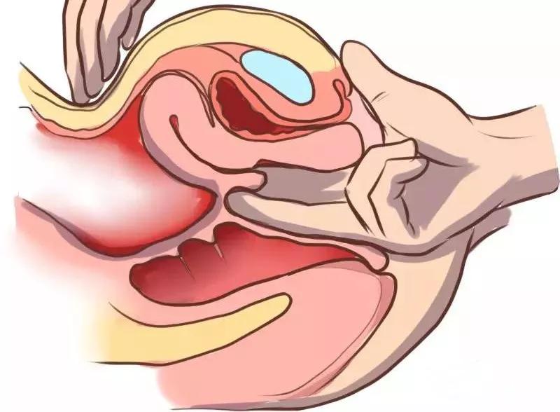 自己如何正确的找到盆底肌,改善盆底肌的正确方法