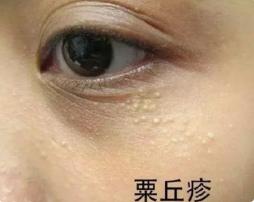 告别脂肪粒,告别脂肪粒的烦恼