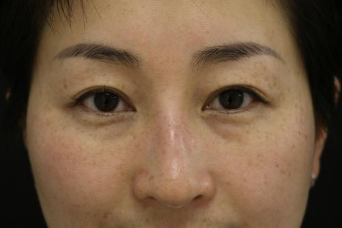 肝脏解毒能力不好的表现,肝脏排毒功能差的人症状