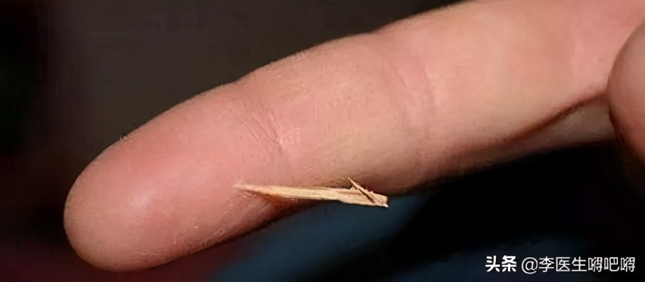 被花刺划破皮怎么办,被玫瑰花刺刮到怎么办