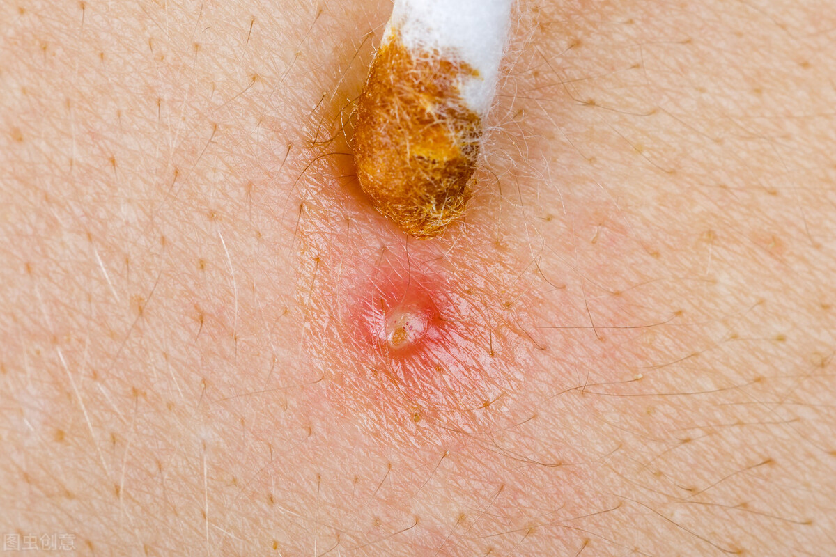 头皮上凸起一个硬疙瘩抠了又长,头皮长疙瘩抠了反复结痂怎么治