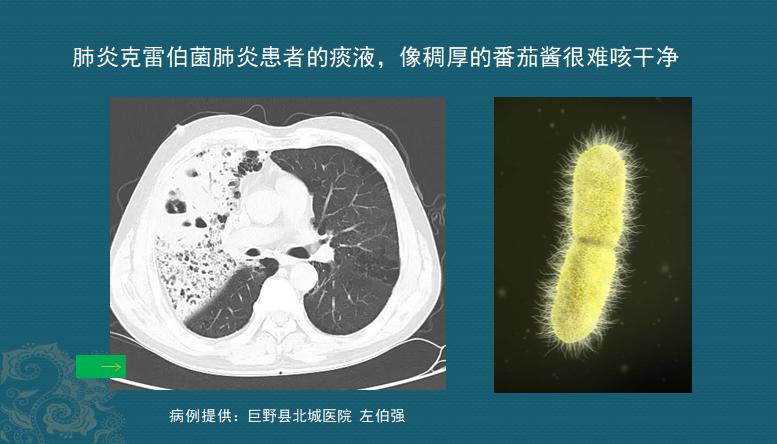 细菌性肺炎吐痰颜色加深,肺炎吐痰粉色需要治疗吗
