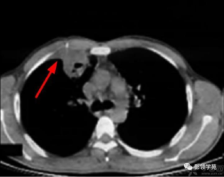 肺肉芽肿影像学表现ppt,肺韦格纳肉芽肿影像学表现