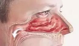 儿童鼻痒鼻塞鼻炎用什么喷剂,小孩鼻塞建议用什么鼻喷雾剂