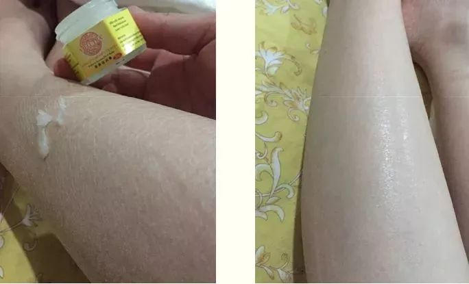 手脚冻疮怎么治断根,冬季治手脚干裂冻疮有效的药