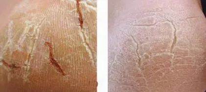 手脚冻疮怎么治断根,冬季治手脚干裂冻疮有效的药