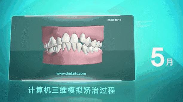 种植牙能降价多少钱啊,牙齿种植牙价格一览表