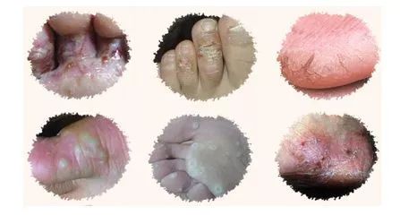 治疗脚气烂脚丫的小妙招,如何治疗脚臭脚气脚后跟开裂