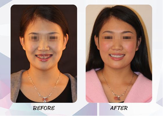 今年种植牙齿进医保了吗,矫正牙齿不给报销吗