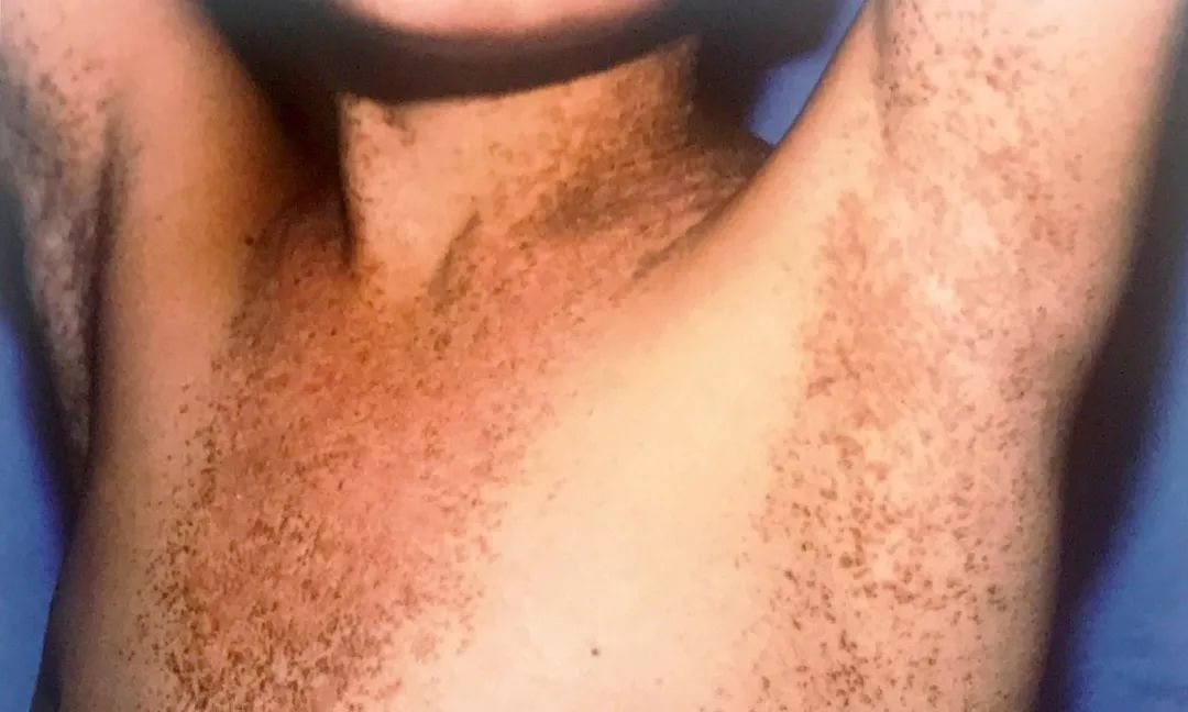 鸡皮肤解决方法又白又嫩学生适用,鸡皮肤太丑了该怎么办