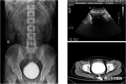 小心膀胱结石,膀胱结石的初期症状是什么