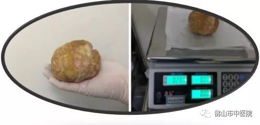 「注意」吓一跳！膀胱结石拳头大，异常信号早警惕