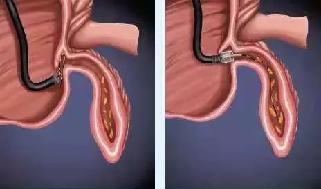 治疗阑尾炎需要手术吗,阑尾炎为什么选择保守治疗呢