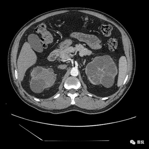 肾功能不全双肾回声稍增强怎么办,肾ct检查双肾萎缩