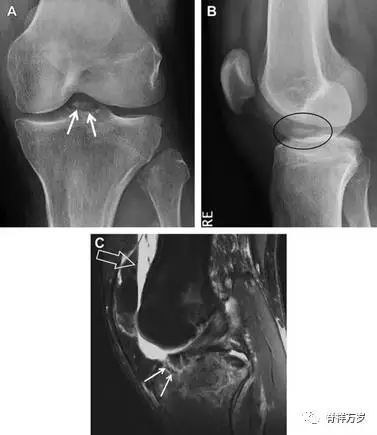 肩关节脱位易漏诊的骨折,放射科容易漏诊的骨折