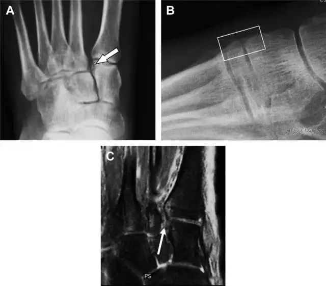 肩关节脱位易漏诊的骨折,放射科容易漏诊的骨折