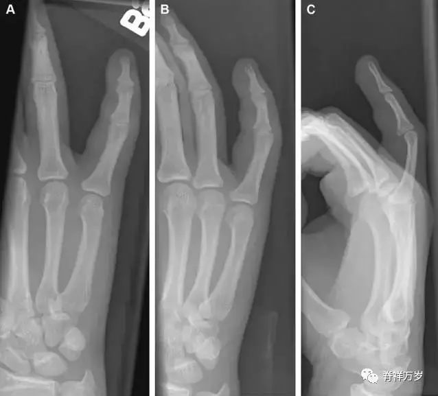 肩关节脱位易漏诊的骨折,放射科容易漏诊的骨折