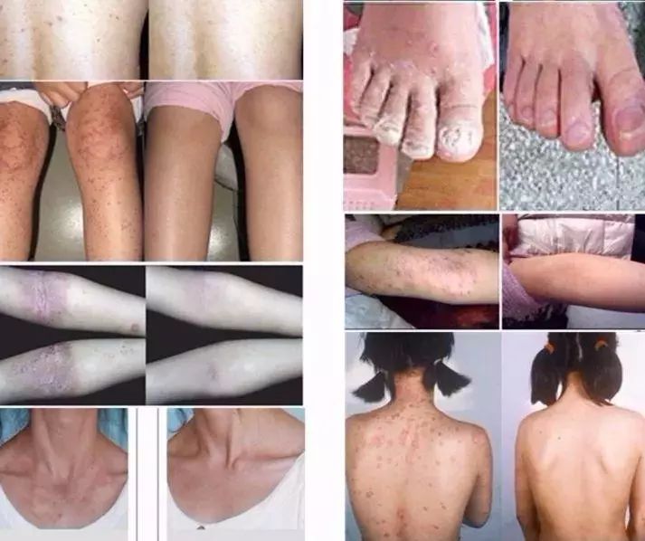 皮肤湿疹万能膏,泰国顽固性皮肤病排毒止痒膏