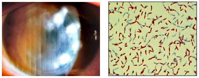 孙旭光眼科医生,孙旭光大夫角膜塑形镜危害