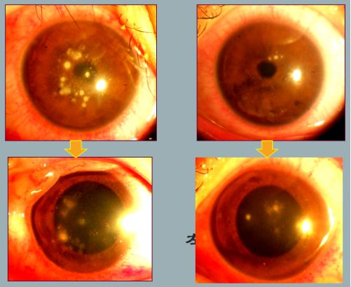 孙旭光眼科医生,孙旭光大夫角膜塑形镜危害