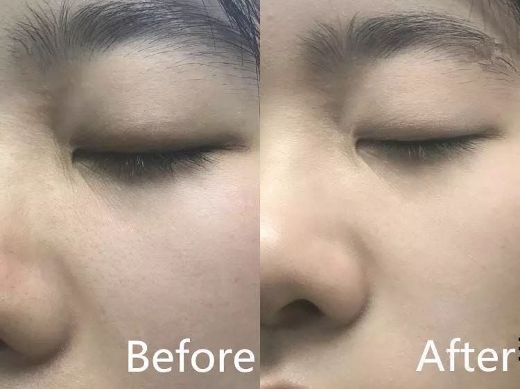 小米洁面仪真的好用吗,小米超声波洁面仪测评