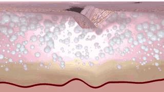 抬头纹眉间纹怎么去除,眉间纹抬头纹去除最好的方法