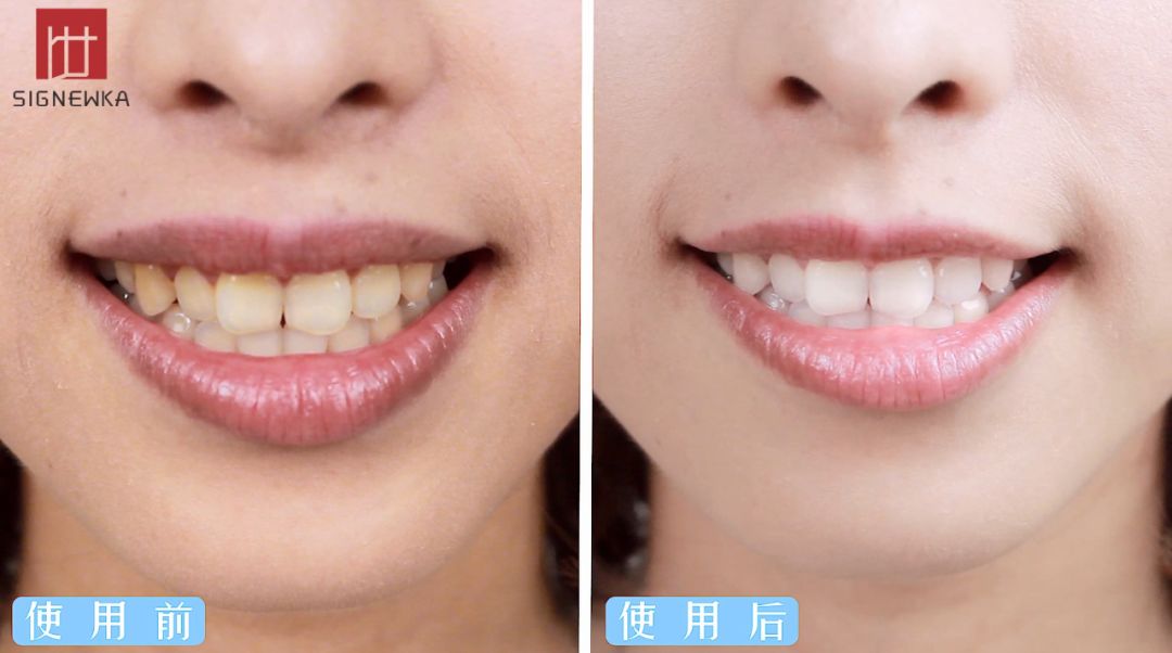 闭着嘴巴一会就干有异味,闭着嘴巴都感觉口腔有异味