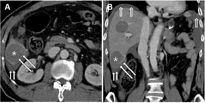 pubmed最新文献如何看全文,pubmed文献推送