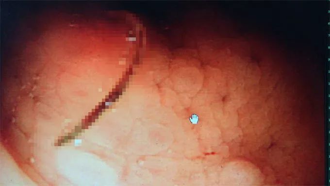 一女子持续便血、头晕两个月！竟与之前的一次旅游有关！常去户外的都要注意……
