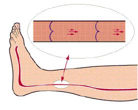 杭州大妈腿部突然喷血！得了这种病，热水泡脚越泡越危险