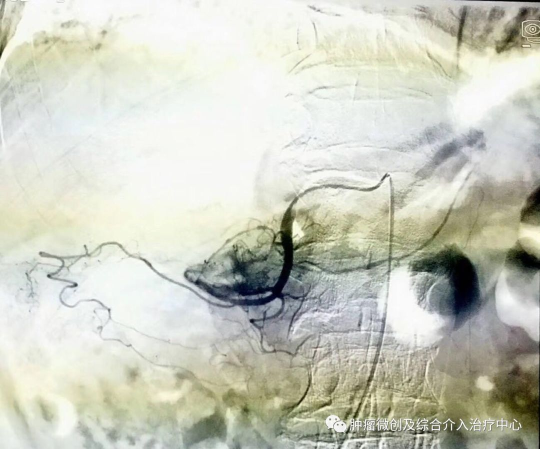 运城市第一医院肿瘤科咋样,运城第一医院治疗肿瘤怎么样