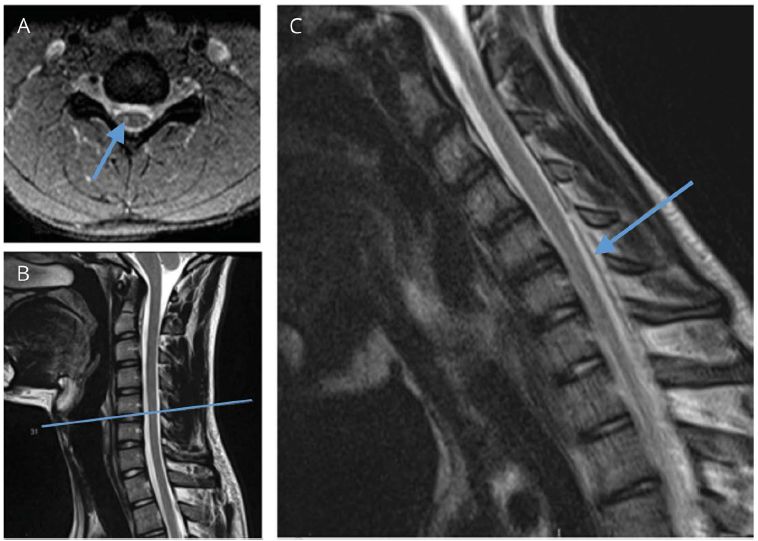 手部无力,年轻人右手无力警惕三种疾病