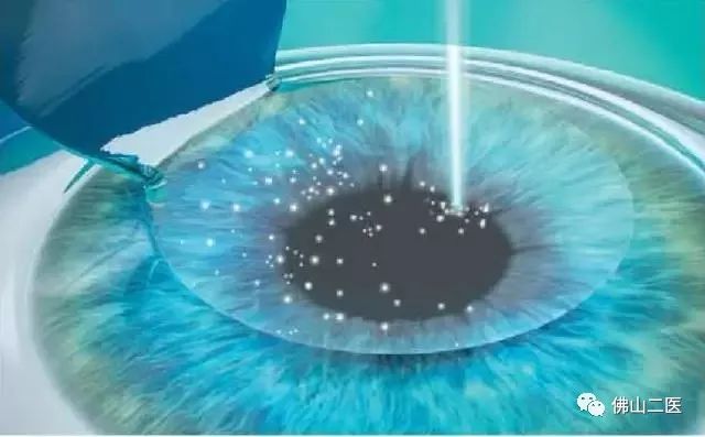 激光近视手术需要多少钱,做近视手术后需要注意事项